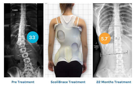 Before-and-after ScoliBrace treatment result