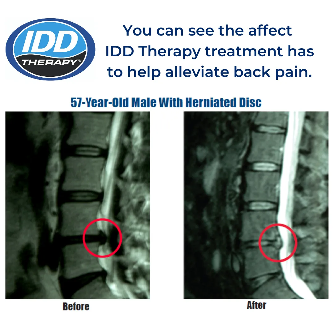 MRI Evidence - ACCU Spina