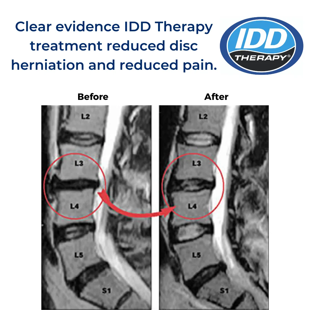 MRI Evidence 2 - ACCU Spina